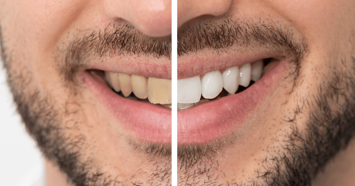 Teeth Whitening